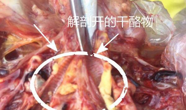 支气管堵塞解剖